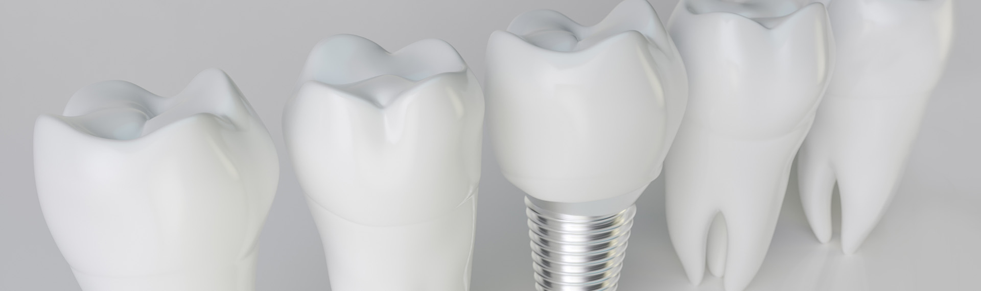 Was kosten Zahnimplantate?